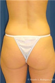 Liposuction Before Photo by Ricardo Rodriguez, MD; Lutherville-Timonium, MD - Case 32622