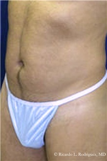 Liposuction After Photo by Ricardo Rodriguez, MD; Lutherville-Timonium, MD - Case 32624