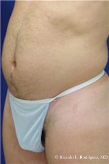 Liposuction Before Photo by Ricardo Rodriguez, MD; Lutherville-Timonium, MD - Case 32624