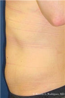 Liposuction After Photo by Ricardo Rodriguez, MD; Lutherville-Timonium, MD - Case 32625