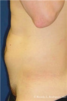 Liposuction Before Photo by Ricardo Rodriguez, MD; Lutherville-Timonium, MD - Case 32625