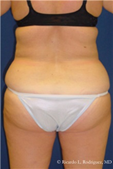 Liposuction Before Photo by Ricardo Rodriguez, MD; Lutherville-Timonium, MD - Case 32627