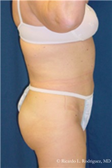 Liposuction After Photo by Ricardo Rodriguez, MD; Lutherville-Timonium, MD - Case 32627