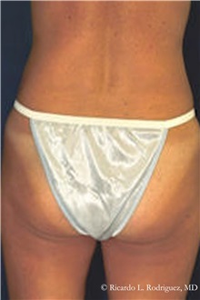 Liposuction After Photo by Ricardo Rodriguez, MD; Lutherville-Timonium, MD - Case 32628