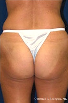 Liposuction Before Photo by Ricardo Rodriguez, MD; Lutherville-Timonium, MD - Case 32628