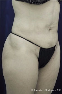 Liposuction After Photo by Ricardo Rodriguez, MD; Lutherville-Timonium, MD - Case 32630