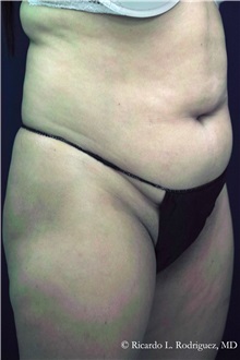 Liposuction Before Photo by Ricardo Rodriguez, MD; Lutherville-Timonium, MD - Case 32630