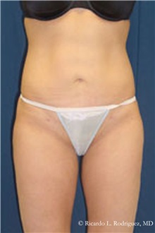Liposuction After Photo by Ricardo Rodriguez, MD; Lutherville-Timonium, MD - Case 32634