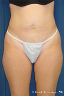Liposuction Before Photo by Ricardo Rodriguez, MD; Lutherville-Timonium, MD - Case 32634