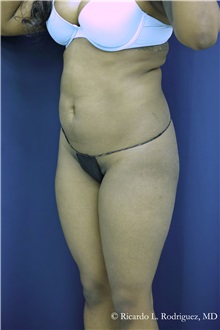 Liposuction Before Photo by Ricardo Rodriguez, MD; Lutherville-Timonium, MD - Case 32636