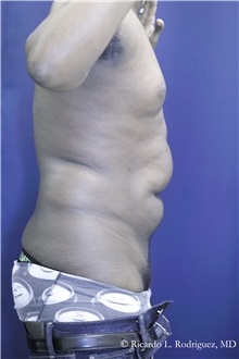 Liposuction Before Photo by Ricardo Rodriguez, MD; Lutherville-Timonium, MD - Case 32638