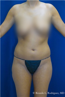Liposuction Before Photo by Ricardo Rodriguez, MD; Lutherville-Timonium, MD - Case 32639
