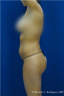 Liposuction After Photo by Ricardo Rodriguez, MD; Lutherville-Timonium, MD - Case 32639