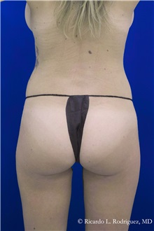 Buttock Implants After Photo by Ricardo Rodriguez, MD; Lutherville-Timonium, MD - Case 32640
