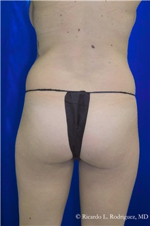Buttock Implants Before Photo by Ricardo Rodriguez, MD; Lutherville-Timonium, MD - Case 32640