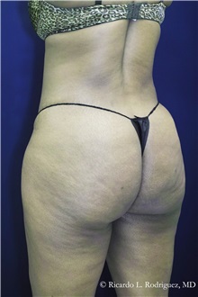 Buttock Implants After Photo by Ricardo Rodriguez, MD; Lutherville-Timonium, MD - Case 32642