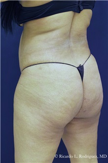 Buttock Implants Before Photo by Ricardo Rodriguez, MD; Lutherville-Timonium, MD - Case 32642