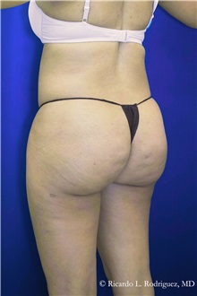 Buttock Implants After Photo by Ricardo Rodriguez, MD; Lutherville-Timonium, MD - Case 32644