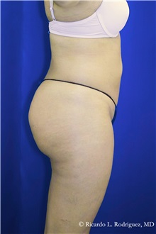 Buttock Implants After Photo by Ricardo Rodriguez, MD; Lutherville-Timonium, MD - Case 32644