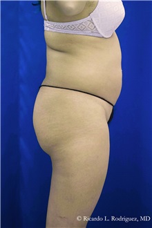 Buttock Implants Before Photo by Ricardo Rodriguez, MD; Lutherville-Timonium, MD - Case 32644