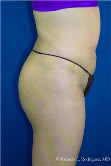 Liposuction After Photo by Ricardo Rodriguez, MD; Lutherville-Timonium, MD - Case 32646