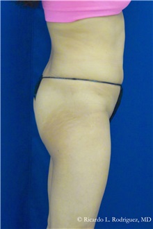 Liposuction Before Photo by Ricardo Rodriguez, MD; Lutherville-Timonium, MD - Case 32646