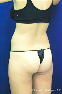 Liposuction Before Photo by Ricardo Rodriguez, MD; Lutherville-Timonium, MD - Case 32648