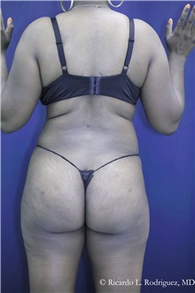 Buttock Implants After Photo by Ricardo Rodriguez, MD; Lutherville-Timonium, MD - Case 32653