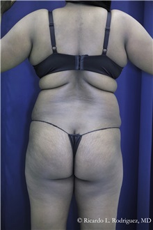 Buttock Implants Before Photo by Ricardo Rodriguez, MD; Lutherville-Timonium, MD - Case 32653