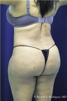Buttock Implants After Photo by Ricardo Rodriguez, MD; Lutherville-Timonium, MD - Case 32655