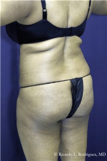 Buttock Implants Before Photo by Ricardo Rodriguez, MD; Lutherville-Timonium, MD - Case 32655