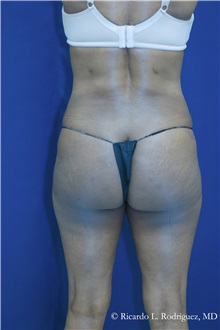 Buttock Implants After Photo by Ricardo Rodriguez, MD; Lutherville-Timonium, MD - Case 32656