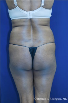 Buttock Implants Before Photo by Ricardo Rodriguez, MD; Lutherville-Timonium, MD - Case 32656