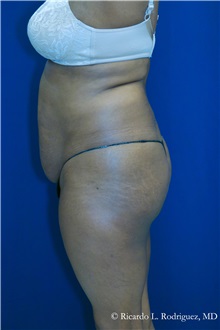 Buttock Implants Before Photo by Ricardo Rodriguez, MD; Lutherville-Timonium, MD - Case 32656