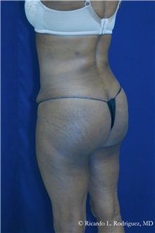 Buttock Implants After Photo by Ricardo Rodriguez, MD; Lutherville-Timonium, MD - Case 32656