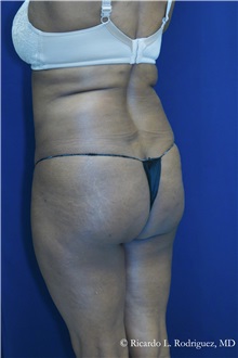 Buttock Implants Before Photo by Ricardo Rodriguez, MD; Lutherville-Timonium, MD - Case 32656