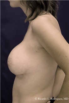 Breast Augmentation After Photo by Ricardo Rodriguez, MD; Lutherville-Timonium, MD - Case 48309