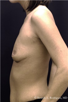Breast Augmentation Before Photo by Ricardo Rodriguez, MD; Lutherville-Timonium, MD - Case 48309