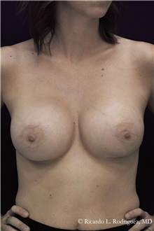 Breast Augmentation After Photo by Ricardo Rodriguez, MD; Lutherville-Timonium, MD - Case 48309
