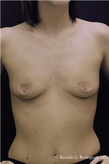 Breast Augmentation Before Photo by Ricardo Rodriguez, MD; Lutherville-Timonium, MD - Case 48309