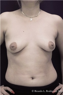 Breast Augmentation Before Photo by Ricardo Rodriguez, MD; Lutherville-Timonium, MD - Case 48310