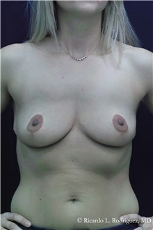 Breast Augmentation Before Photo by Ricardo Rodriguez, MD; Lutherville-Timonium, MD - Case 48311