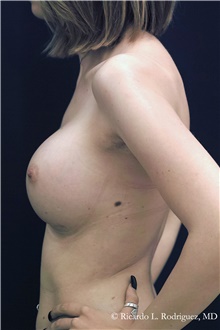 Breast Augmentation After Photo by Ricardo Rodriguez, MD; Lutherville-Timonium, MD - Case 48313
