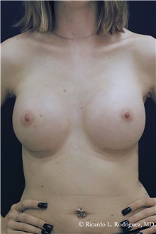 Breast Augmentation After Photo by Ricardo Rodriguez, MD; Lutherville-Timonium, MD - Case 48313