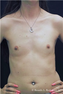 Breast Augmentation Before Photo by Ricardo Rodriguez, MD; Lutherville-Timonium, MD - Case 48313