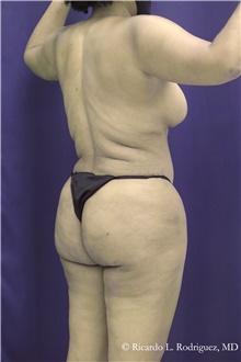 Buttock Implants After Photo by Ricardo Rodriguez, MD; Lutherville-Timonium, MD - Case 48314