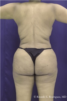 Buttock Implants After Photo by Ricardo Rodriguez, MD; Lutherville-Timonium, MD - Case 48314