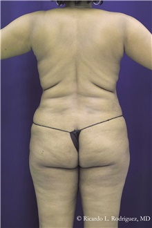Buttock Implants Before Photo by Ricardo Rodriguez, MD; Lutherville-Timonium, MD - Case 48314