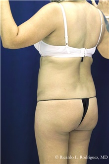 Buttock Implants Before Photo by Ricardo Rodriguez, MD; Lutherville-Timonium, MD - Case 48315