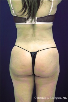 Buttock Implants After Photo by Ricardo Rodriguez, MD; Lutherville-Timonium, MD - Case 48315